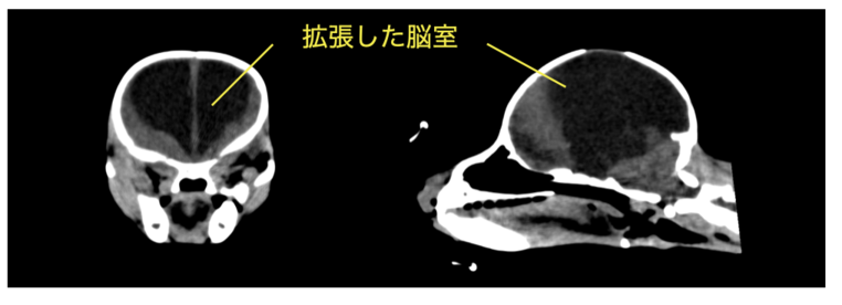 症例3：水頭症