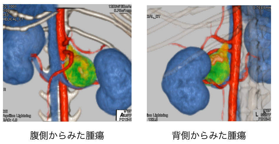 症例6：副腎腫瘍