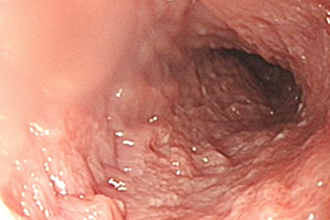 症例1：炎症性腸炎(IBD) 