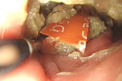症例5：内視鏡で摘出した異物