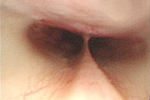 症例6：鼻腔内の内視鏡検査