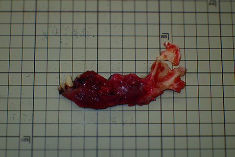 例2：左の下顎にできた腫瘍